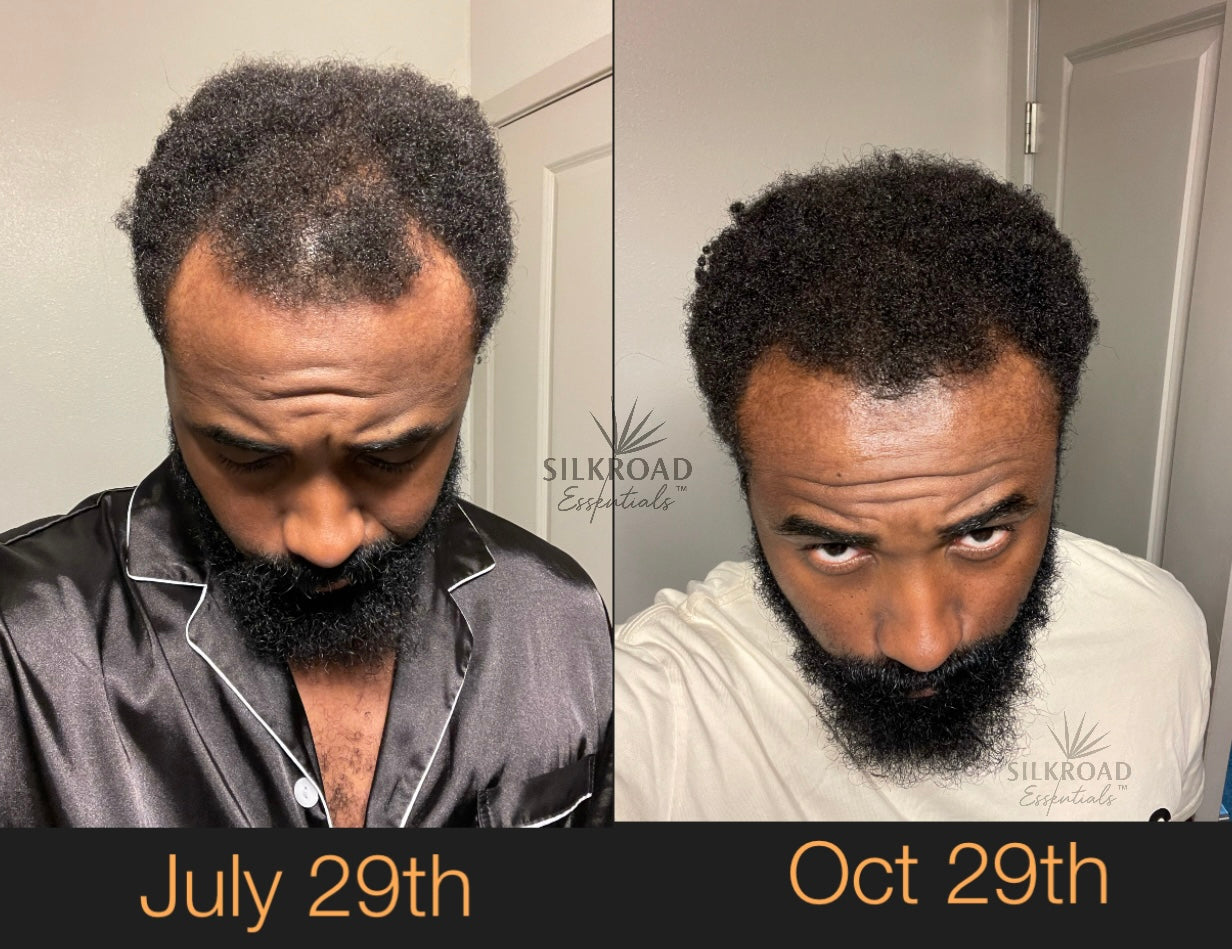 Silkroad Essentials™ DHT-Balancing Elixir — Advanced Scalp Therapy for Density, Strength & Growth